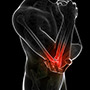 Biceps Tendon Tear at the Elbow