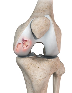 Chondral (Articular Cartilage) Defects