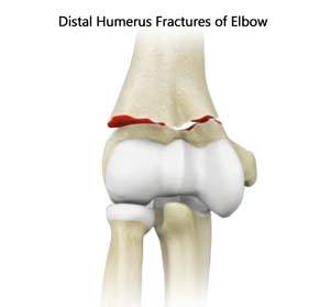 Distal Humerus Fracture of the Elbow