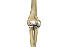 Osteoarthritis of the Elbow