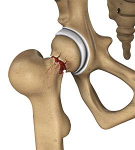 Hip Injuries & Tears