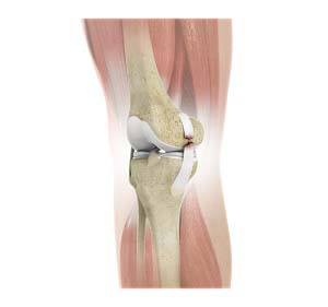 Medial Collateral Ligament Tears (MCL)
