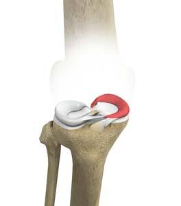 Tibial Eminence Fractures