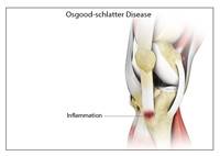 Osgood Schlatter