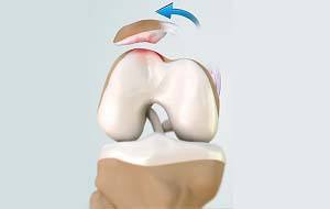 Patellofemoral Instability Knee