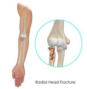 Radial Head Fractures of The Elbow