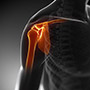 Conventional Shoulder Replacement
