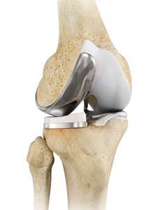 Unicompartmental Knee Replacement